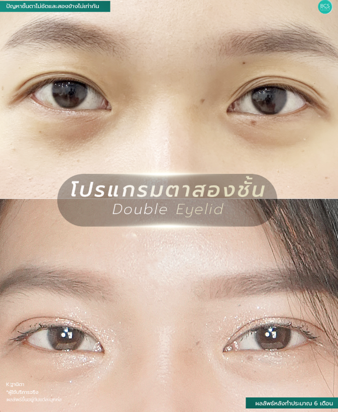 BCS Before and After 1