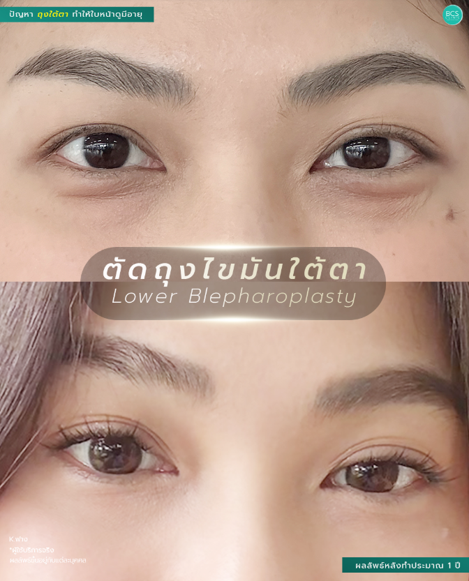 BCS Before and After 2