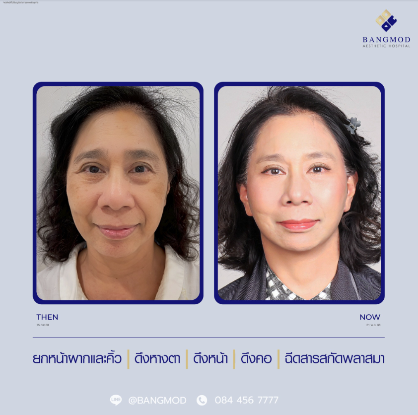 Bangmod Aesthetic Hospital Before and After 2