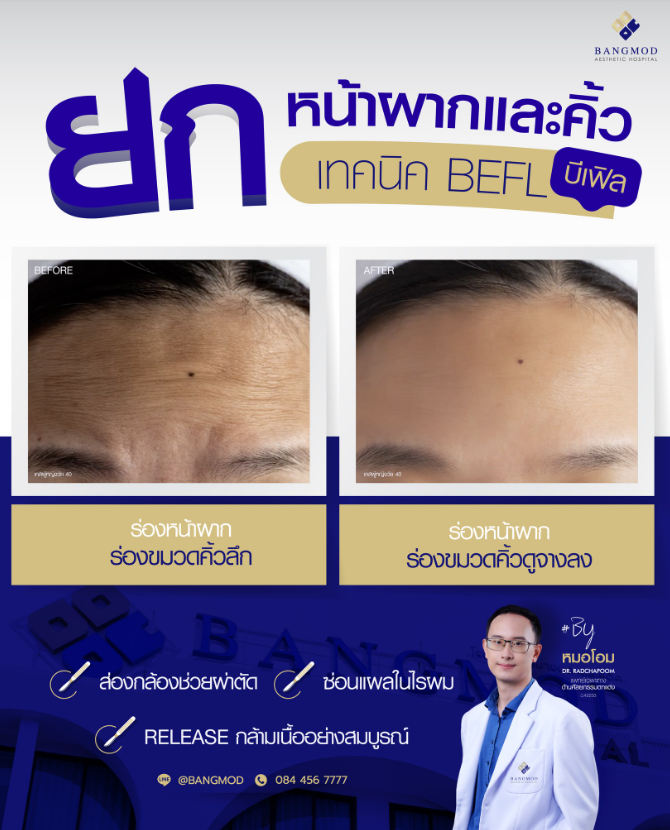 Bangmod Aesthetic Hospital Before and After 5