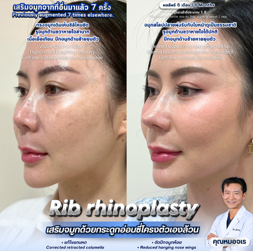 Dr. Jaray Krainam before and after 2