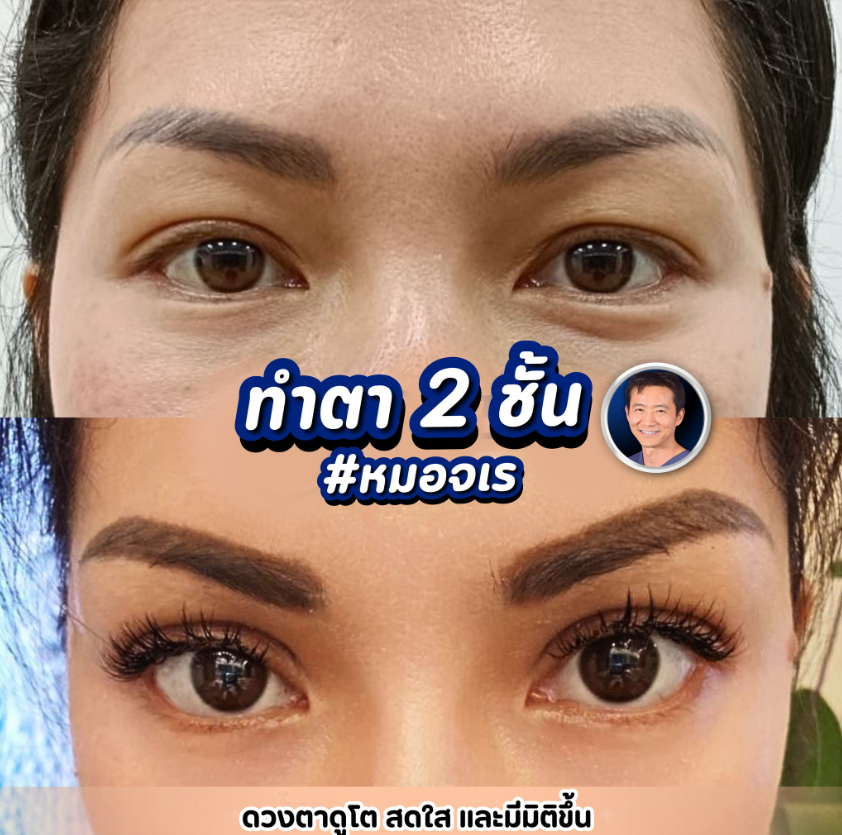 Dr. Jaray Krainam before and after 4