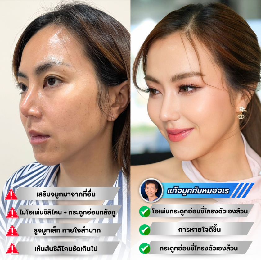 Dr. Jaray Krainam before and after 5