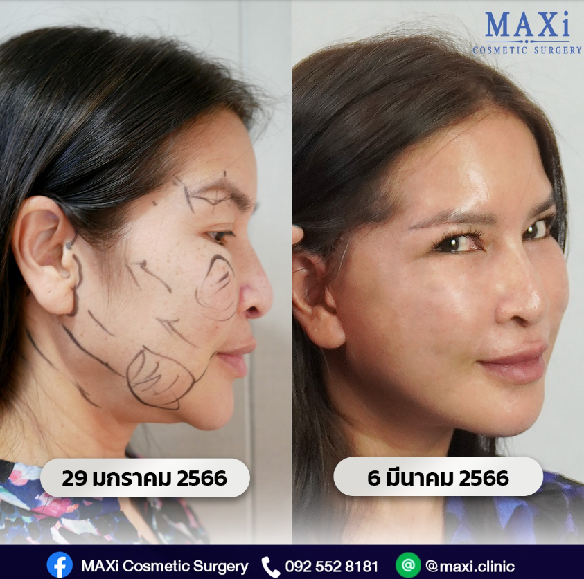 MAXi Cosmetic Surgery before and after 3