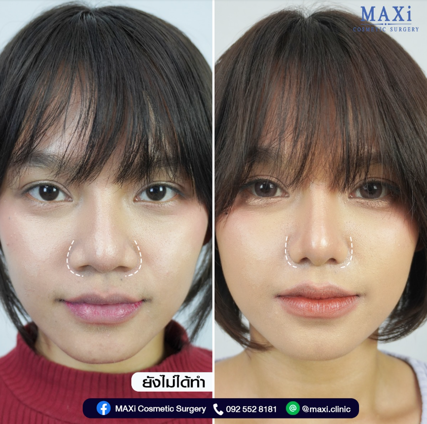 MAXi Cosmetic Surgery before and after 4