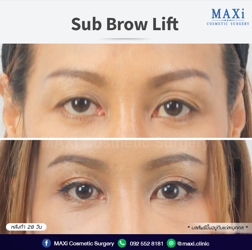 MAXi Cosmetic Surgery before and after 5