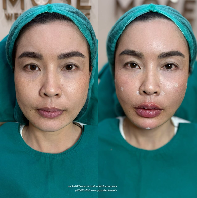 Mose Wellness clinic before and after 1