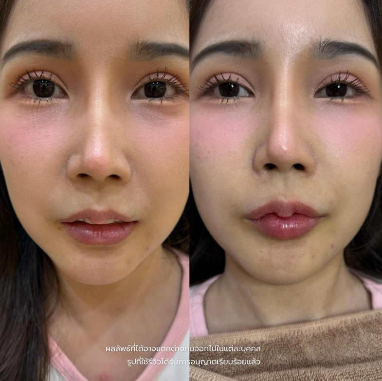 Mose Wellness clinic before and after 3