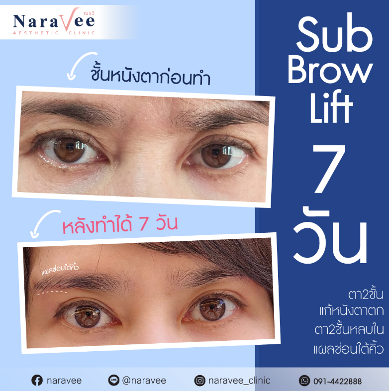 Naravee Clinic before and after 2