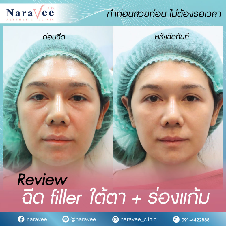 Naravee Clinic before and after 3