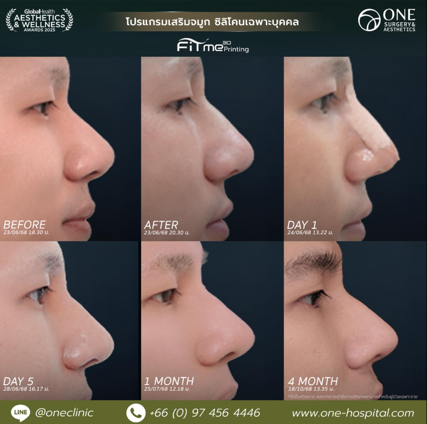 ONE Surgery & Aesthetics Clinic before and after 1