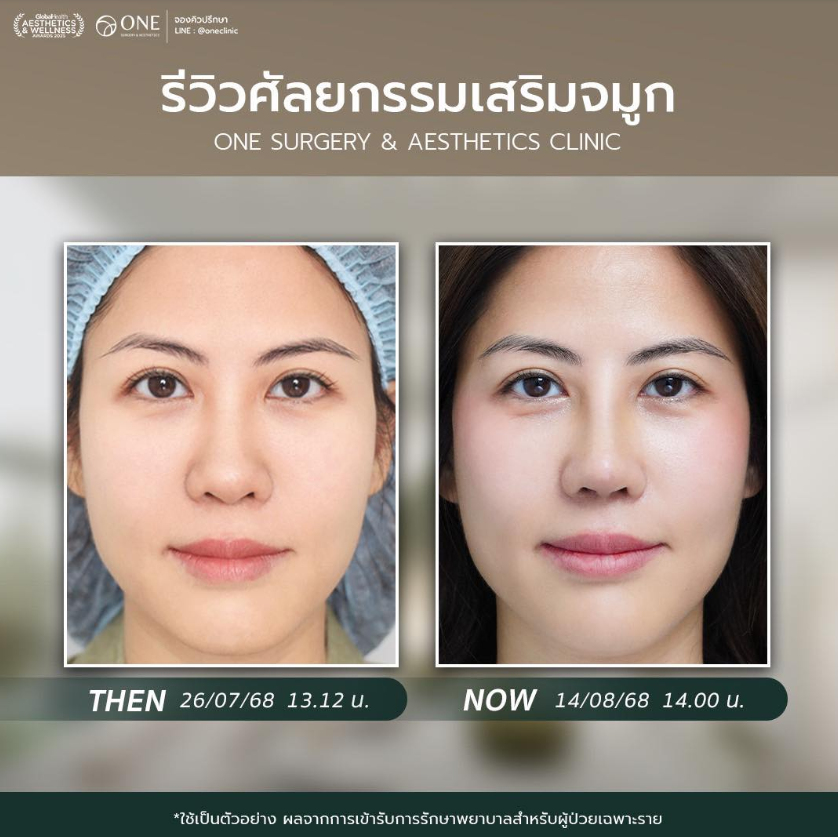 ONE Surgery & Aesthetics Clinic before and after 5