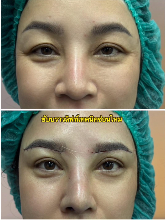 T.R.A. Clinic By Dr.Ying before and after 1
