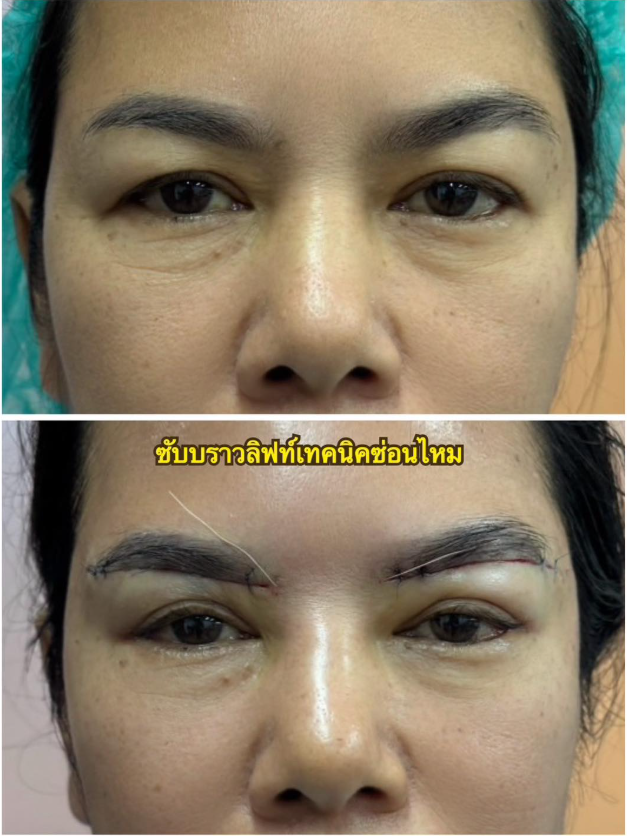 T.R.A. Clinic By Dr.Ying before and after 2
