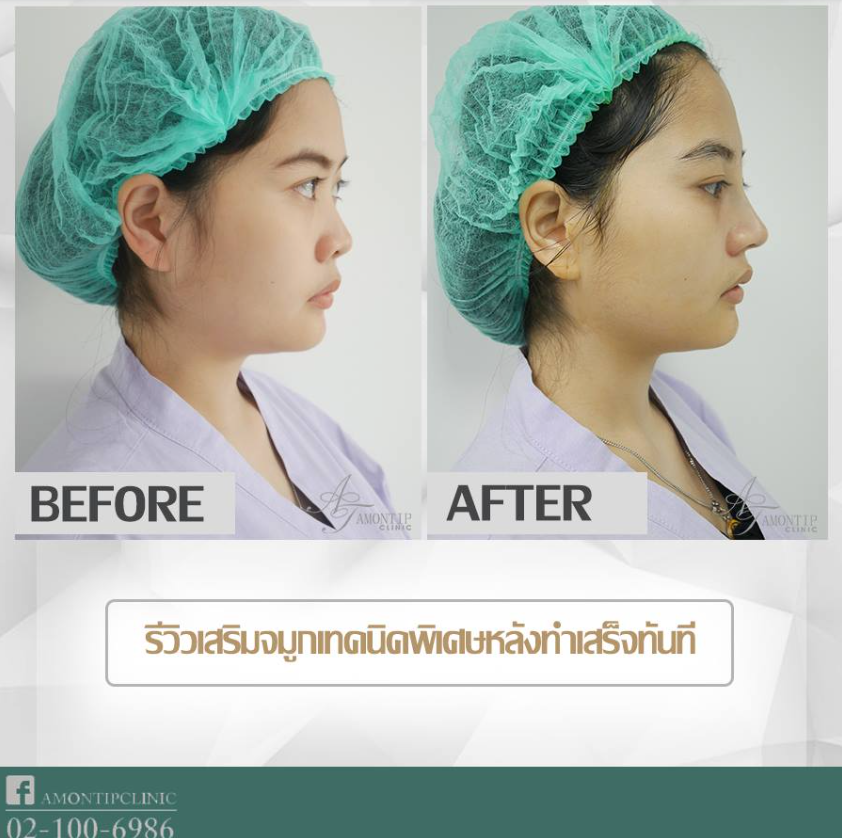 Thanida Clinic Before and After 1