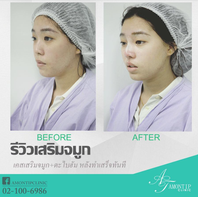 Thanida Clinic Before and After 2