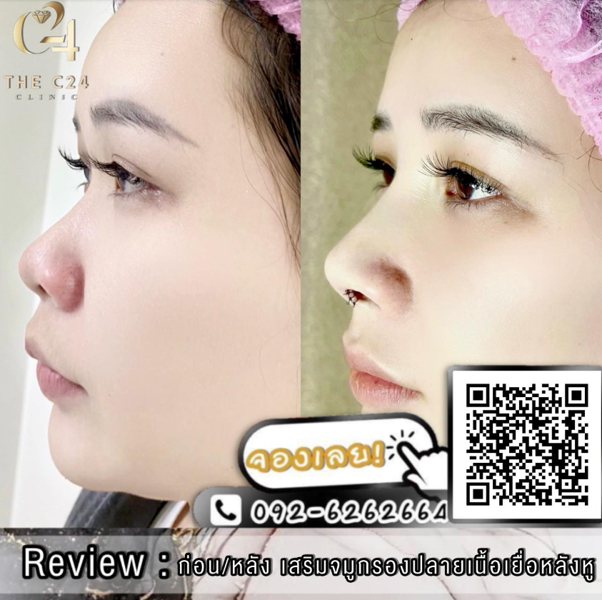 The C24 Clinic before and after 1