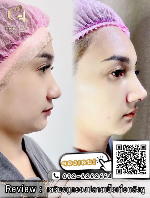 The C24 Clinic before and after 3