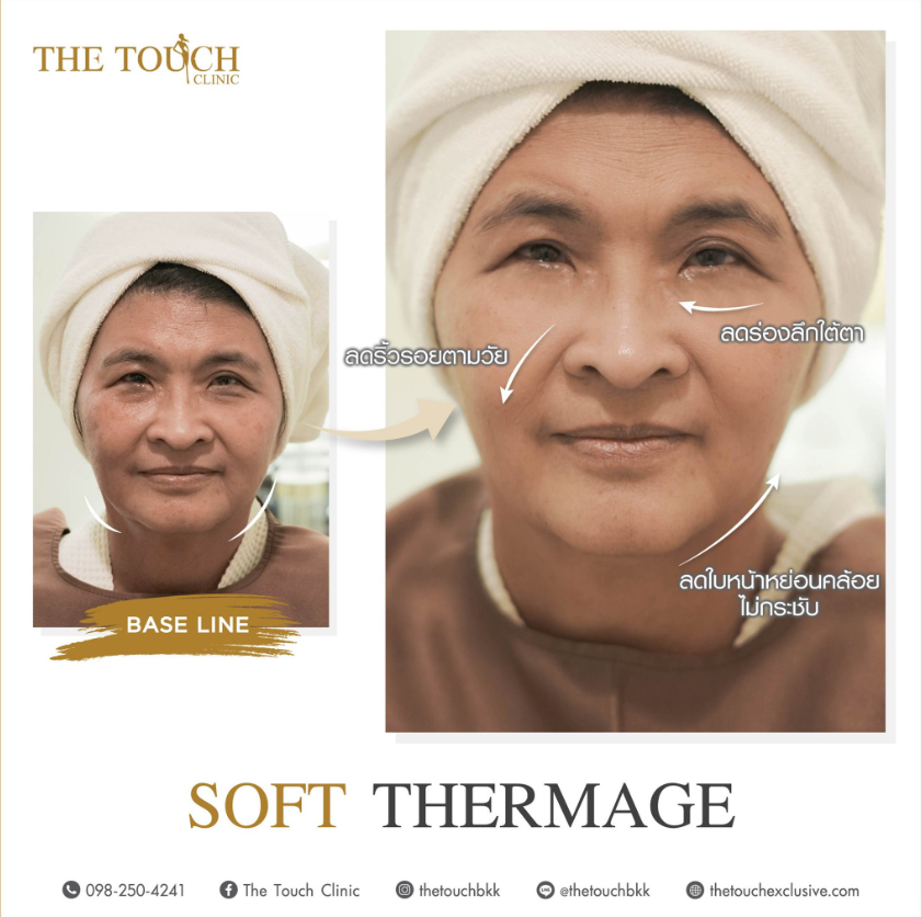 The Touch Clinic before and after 1