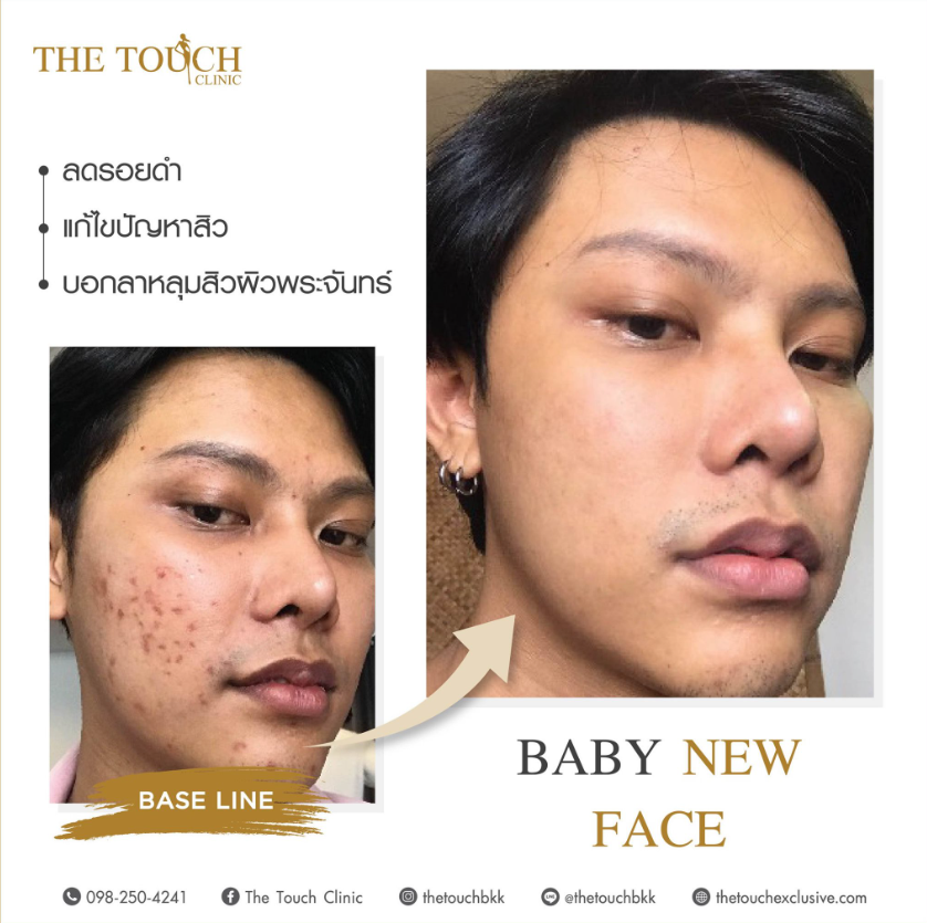 The Touch Clinic before and after 2