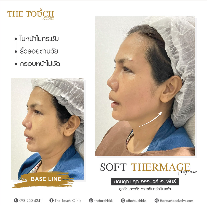 The Touch Clinic before and after 3