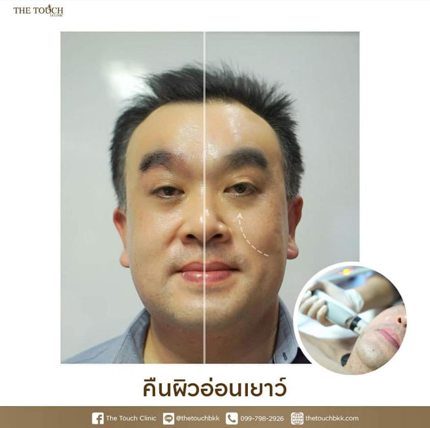 The Touch Clinic before and after 4