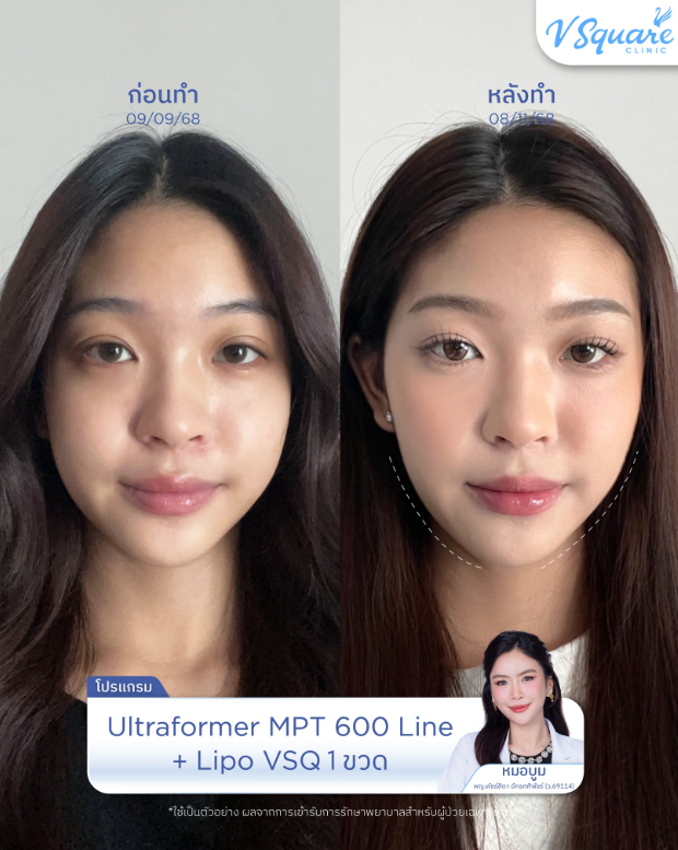 V Square Clinic before and after 2
