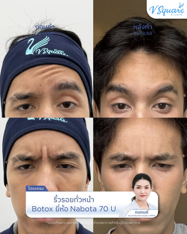 V Square Clinic before and after 3