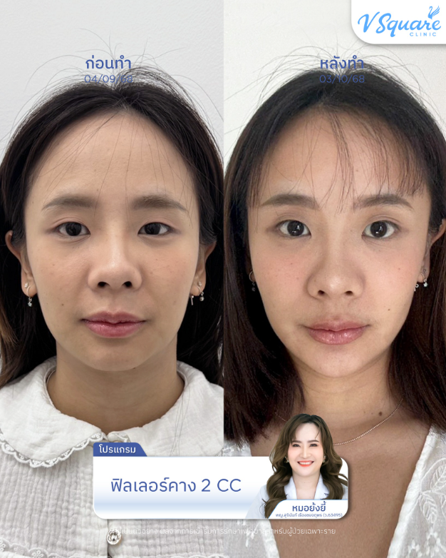 V Square Clinic before and after 4