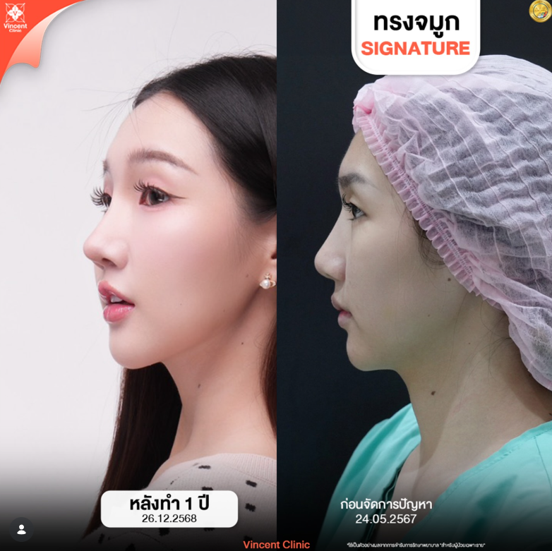 Vincent Clinic before and after 4