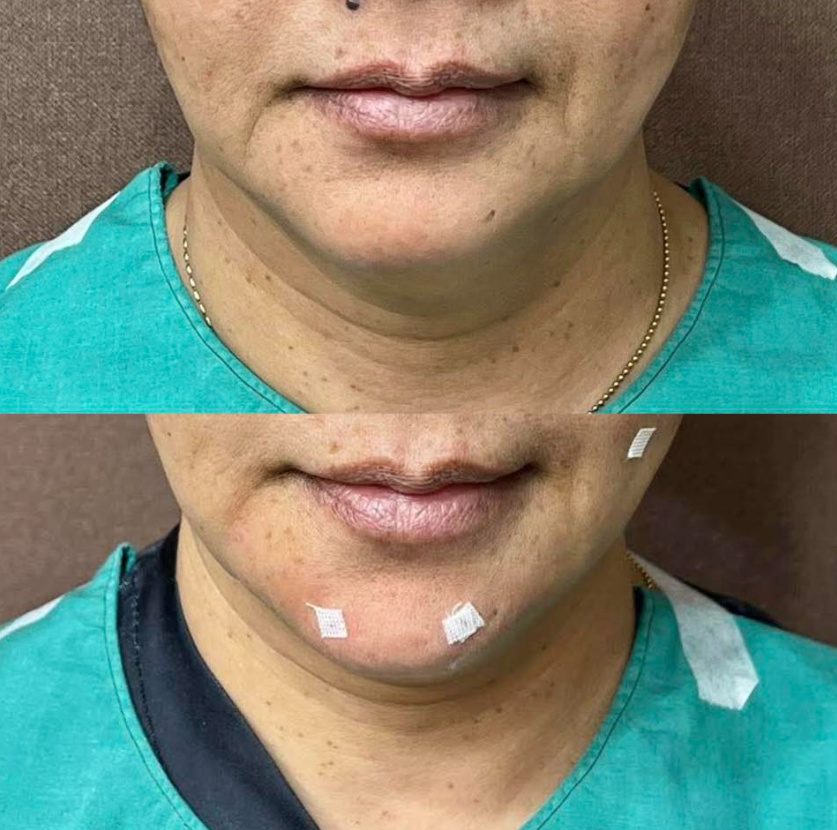 Wan Suk Clinic before and after 2