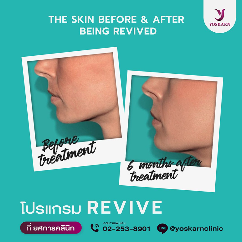 Yoskarn Clinic before and after 2