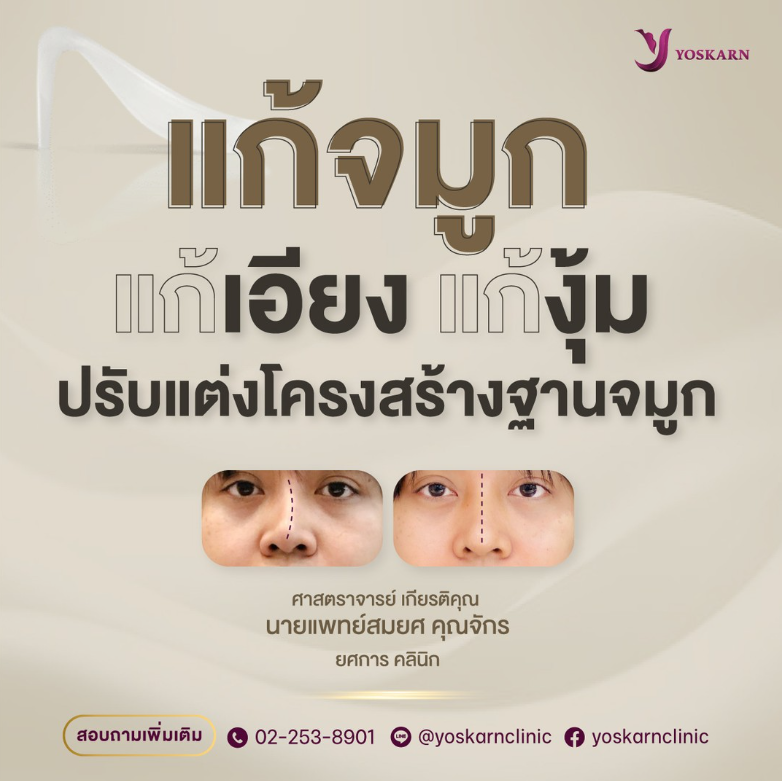 Yoskarn Clinic before and after 4