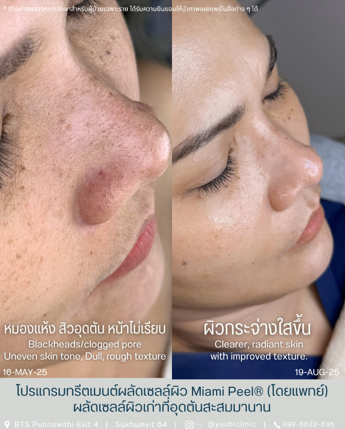 Yuubi clinic bafore and after 2