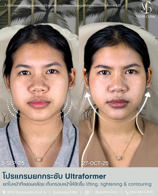 Yuubi clinic bafore and after 5