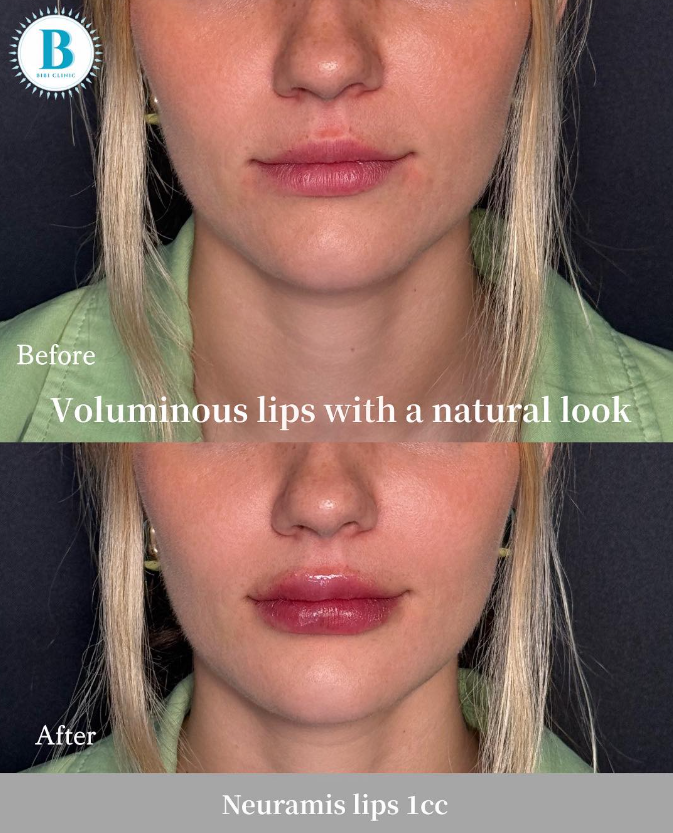 Bibi Clinic before and after 2