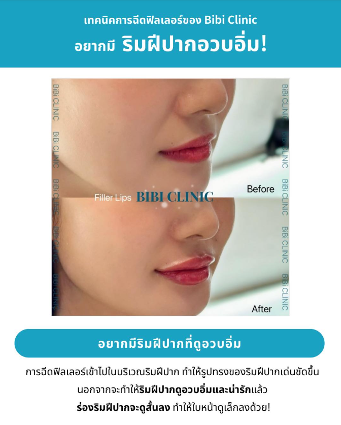 Bibi Clinic before and after 4