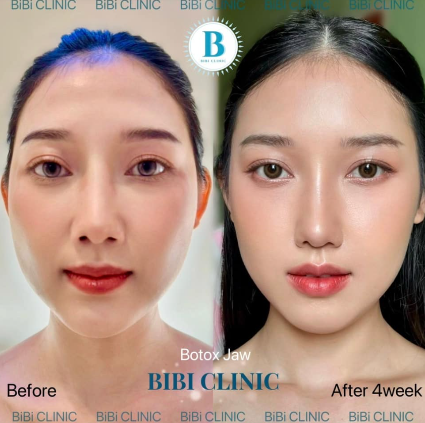 Bibi Clinic before and after 5