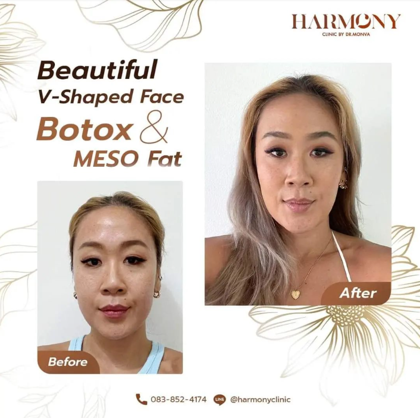 Harmony Clinic before and after 1