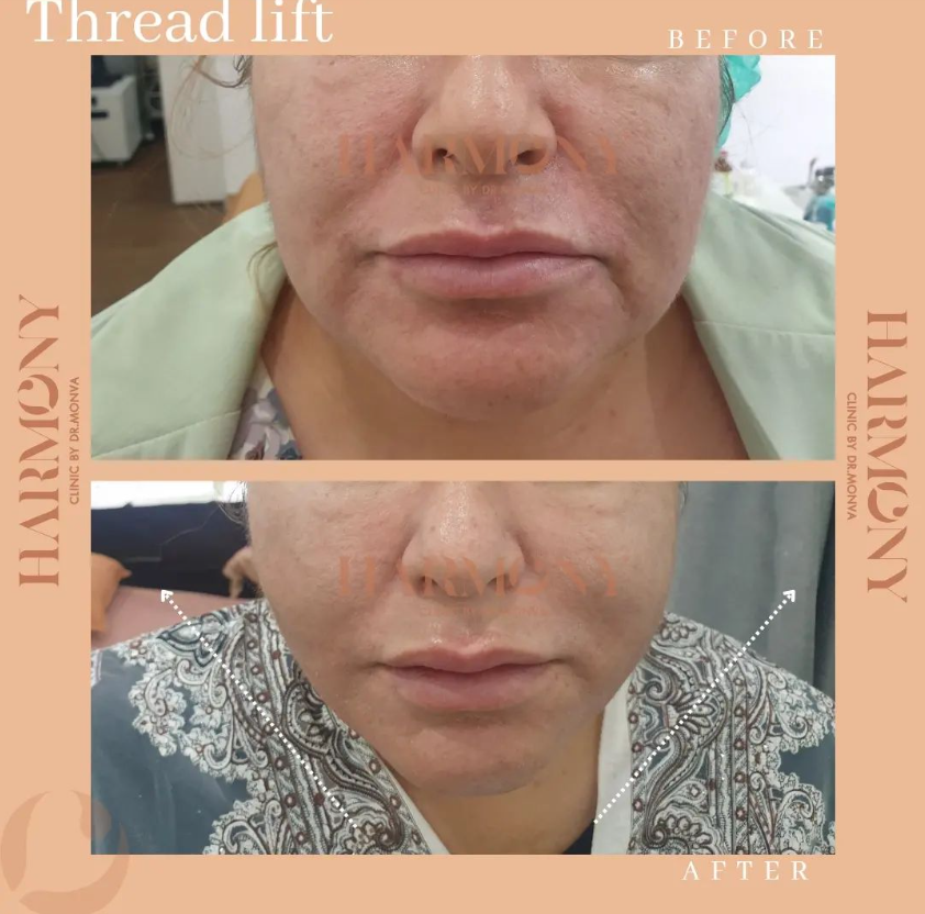 Harmony Clinic before and after 2