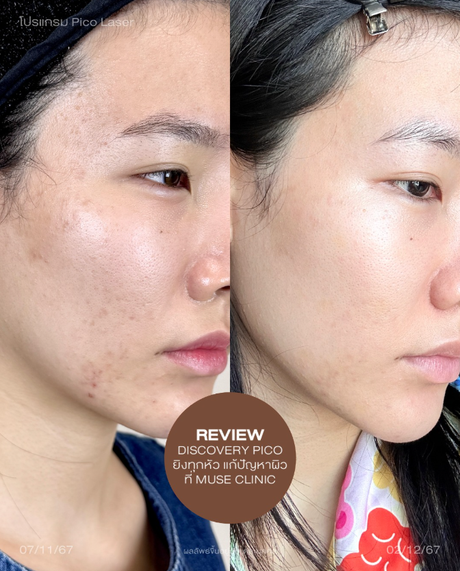 Muse clinic Before and after 1