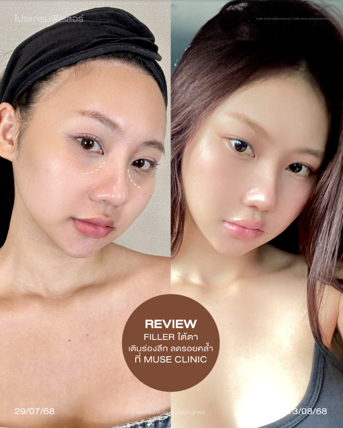 Muse clinic Before and after 2