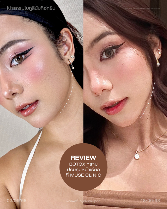 Muse clinic Before and after 3