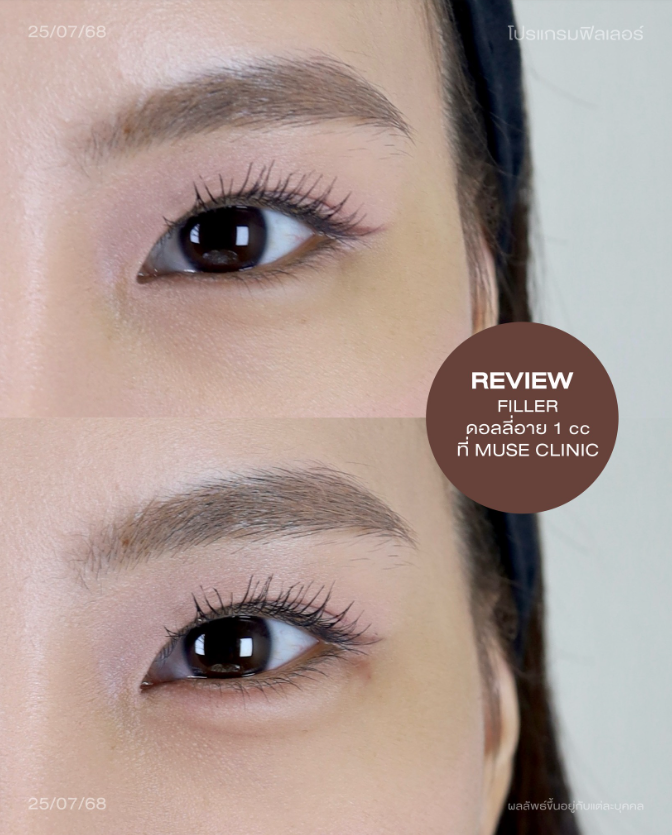 Muse clinic Before and after 4