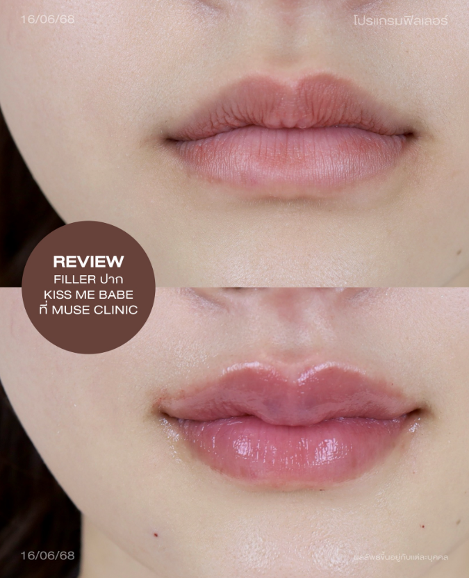 Muse clinic Before and after 5