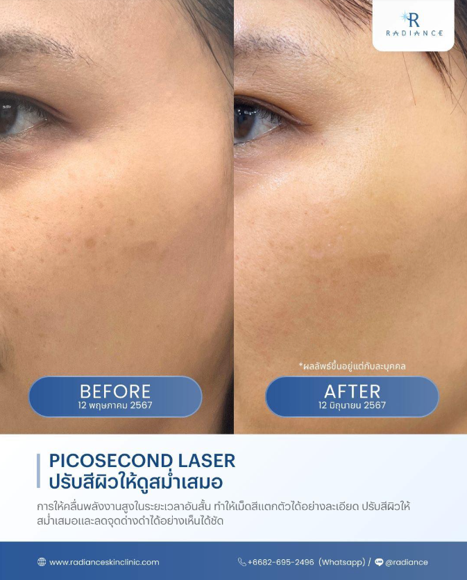 Radiance Clinic Before and After 2