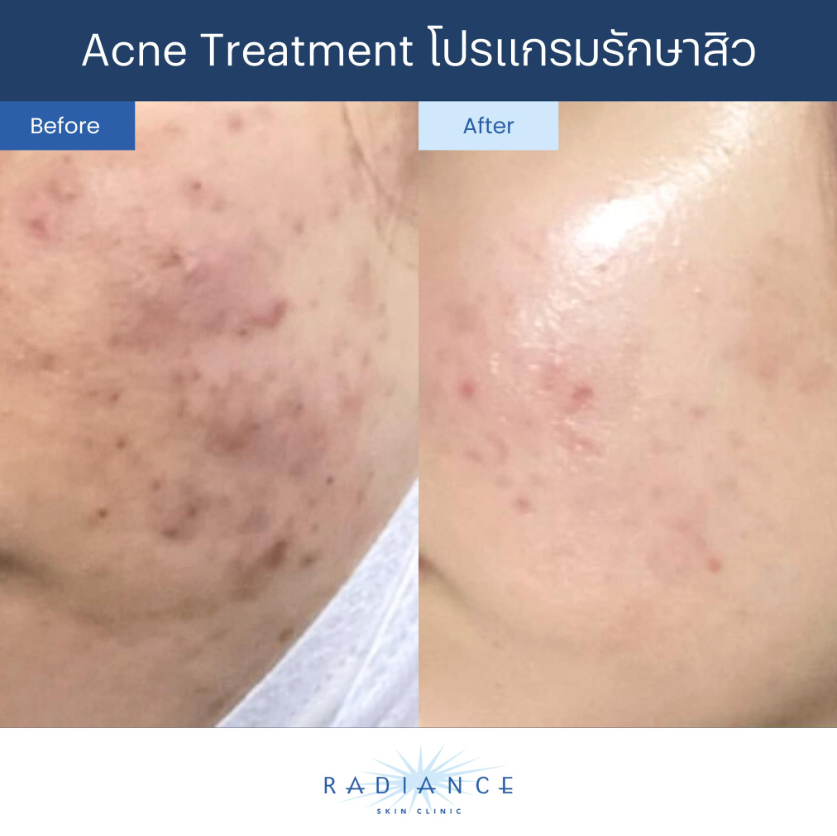 Radiance Clinic Before and After 3