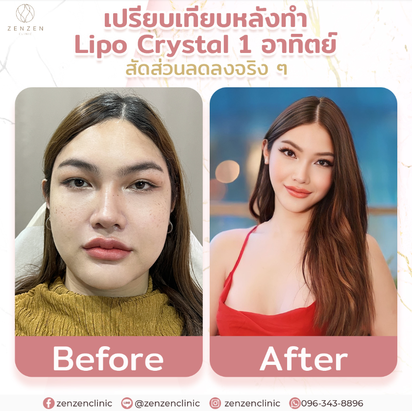 Zenzen Clinic before and after 1