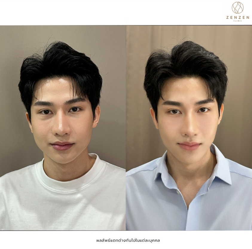 Zenzen Clinic before and after 2