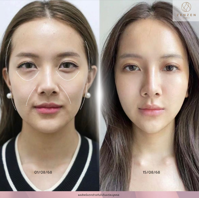 Zenzen Clinic before and after 3